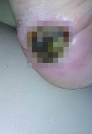 بثرة صغيرة أدت الى بتر ساقها... هذا ما حصل مع تشارلي العشرينية! (صور)