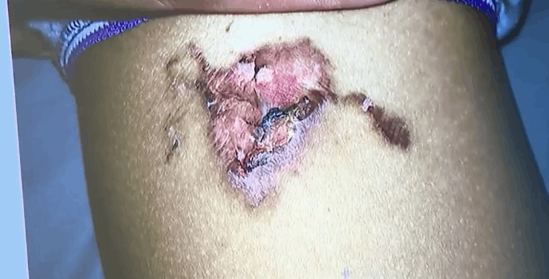  وقعت على فخذها فشوهتها ... 800 ألف دولار تعويضا لطفلة من مطعم مشهور بسبب قطعة دجاج!