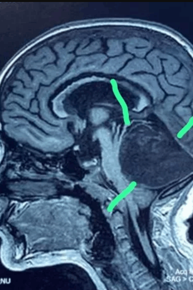 جراحون عثروا على كتلة غريبة في دماغ ابنة الـ8 سنوات... ما اكتشفوه غريب ولا يصدق! (صور)