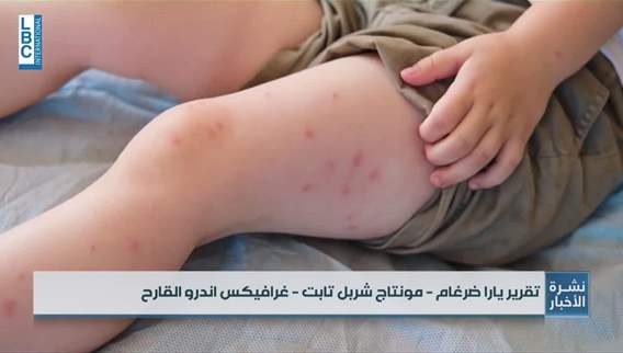 مرض الحصبة في تكساس بين الموت واللقاح!